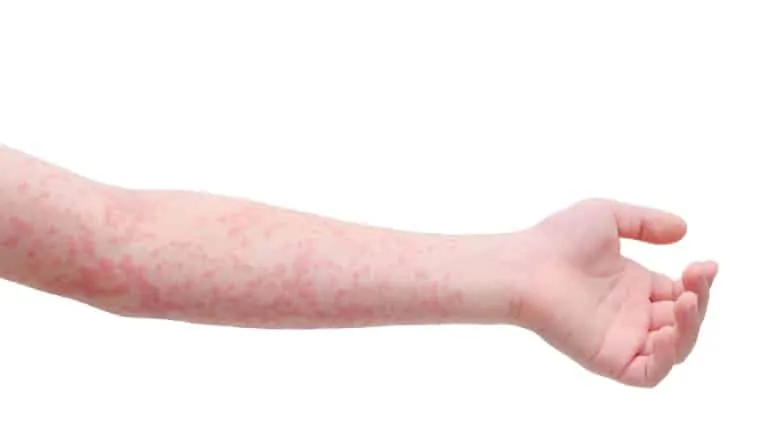 arm with measles